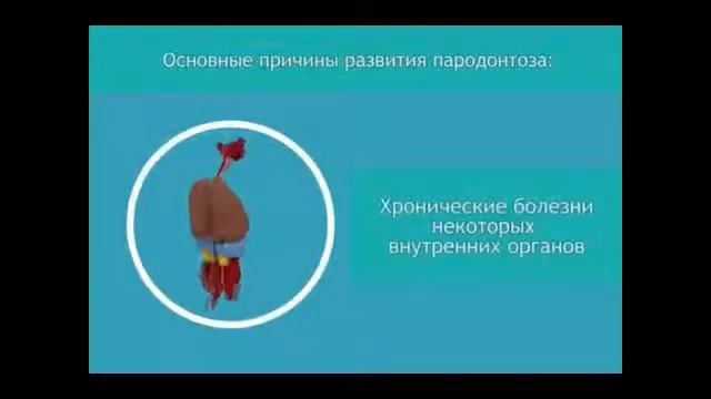 Что такое пародонтоз. Лечение пародонтоза в СПб смотреть онлайн
