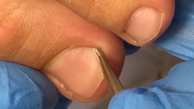 Вросший ноготь у ребёнка ❗️?⚠️??