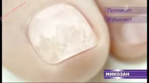 Реклама Микозан - Ваши ногти снова здороввы