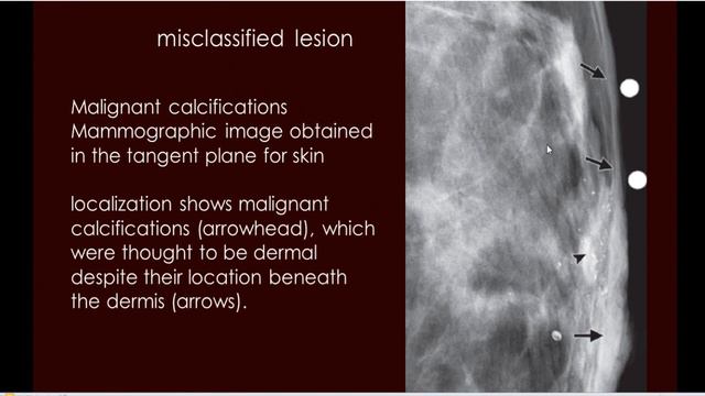 6 sonomammography ACR BIRAD breast skin lesion смотреть онлайн