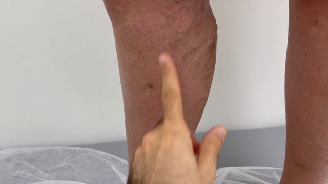 Варикозная вена. Планируем удаление. Узи сосудов. Сосудистый хирург. Флеболог Москва смотреть онлайн