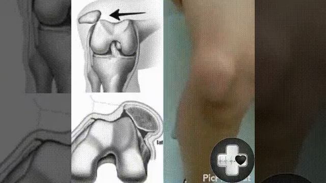 Смещение коленной чашечки смотреть онлайн