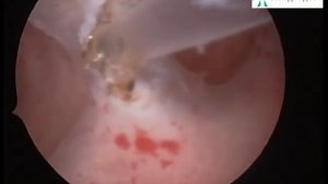 Офисная гистероскопия - удаление синехий