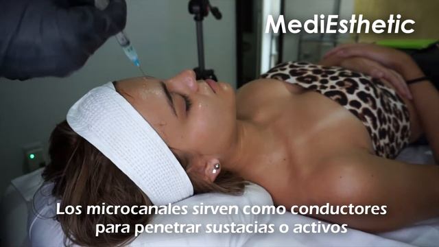 Microneedling DERMAHEAL