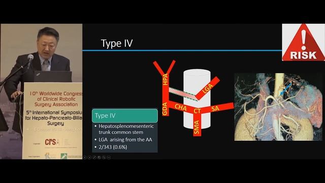 Accurate Lymph Node Dissection For Gastric Cancer Navigated By The Preoperative Imaging смотреть онлайн
