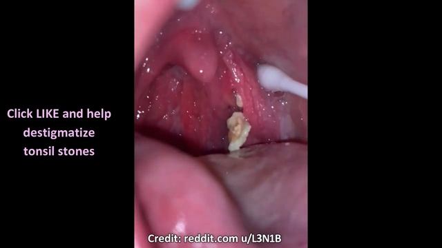 Tonsil Stones, Tonsil Stone, Tonsilloliths! All About Tonsil Stones смотреть онлайн