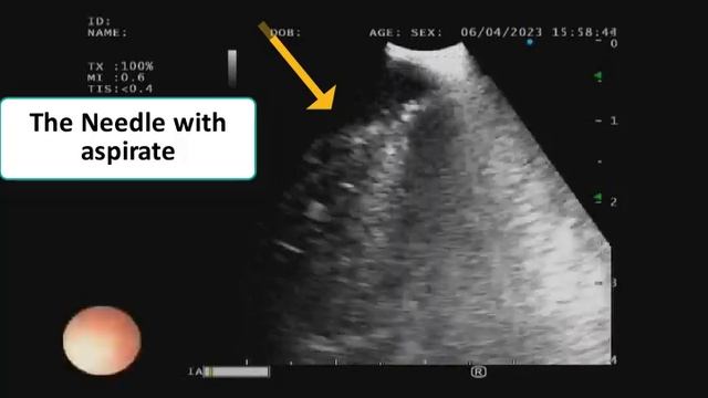 Bronchoscopy with EBUS TBNA. Dr. M. M. Khair & Z. H. Zarker Sir #Dhaka_endosscopy #pulmonology #bsh смотреть онлайн
