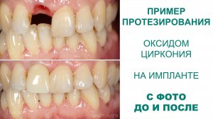 Протезирование переднего зуба на импланте коронкой из оксида циркония