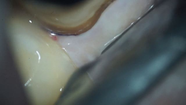 ИЗВЛЕЧЕНИЕ РАЗБОРНОЙ КУЛЬТЕВОЙ ВКЛАДКИ 46 ЗУБА И ВОССТАНОВЛЕНИЕ СВШ+EMAX КОРОНКОЙ (ЧАСТЬ 2) смотреть онлайн