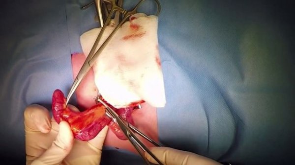 Аппендэктомия I Appendectomy