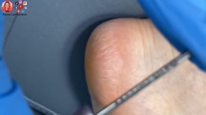 Пятки трескаются - что делать?? Аппаратный педикюр пяток