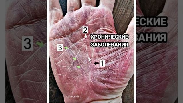 Хронические заболевания по Линии Жизни смотреть онлайн