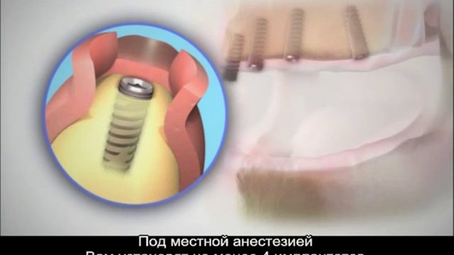 Съемное протезирование на имплантах смотреть онлайн