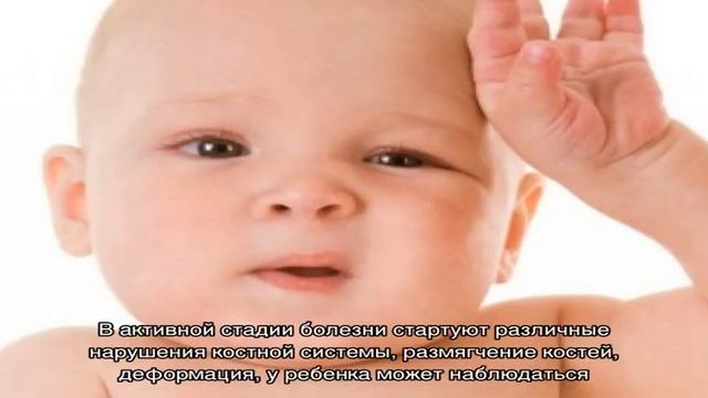 Доктор Комаровский о рахите смотреть онлайн