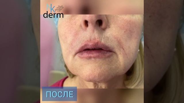 Коррекция лица full-face смотреть онлайн