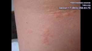 Укусы постельных клопов на людях и детях
