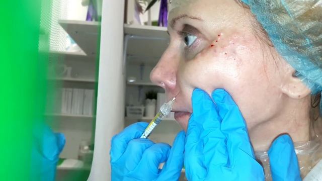 КАК ДЕЛАТЬ БИОРЕВИТАЛИЗАЦИЮ САМОЙ СЕБЕ смотреть онлайн