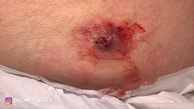 BLACKHEAD Revenge Part 1B, The Ruptured Cyst From Hell