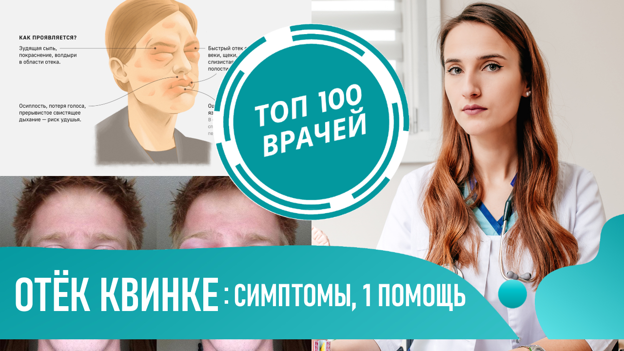 Как выглядит Отёк Квинке: фото, симптомы, первая помощь в домашних условиях. Ангионевротический отёк
