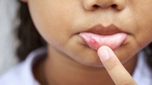 СТОМАТИТ У РЕБЕНКА | Как выглядит и как лечить стоматит