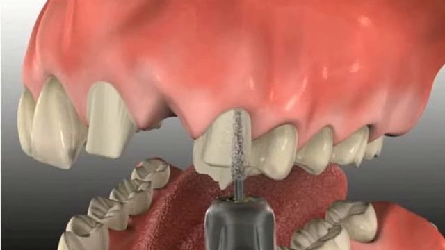 Мостовидный протез смотреть онлайн