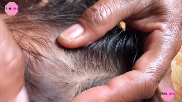 Removing Thousands Of Lice From Long Hair How To Remove It смотреть онлайн