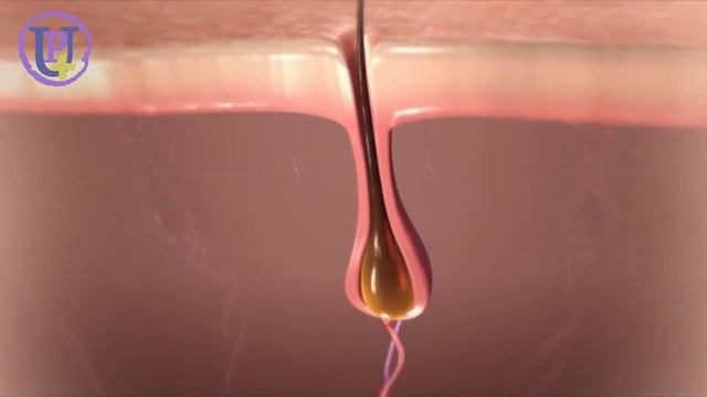 Эпиляция диодным лазером