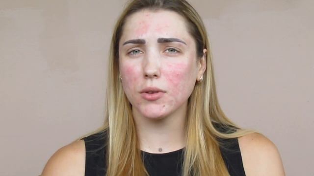 ВСЕ О ГИАЛУРОНОВОЙ КИСЛОТЕ / ГИАЛУРОНОВАЯ КИСЛОТА ПРОТИВ ШРАМОВ смотреть онлайн