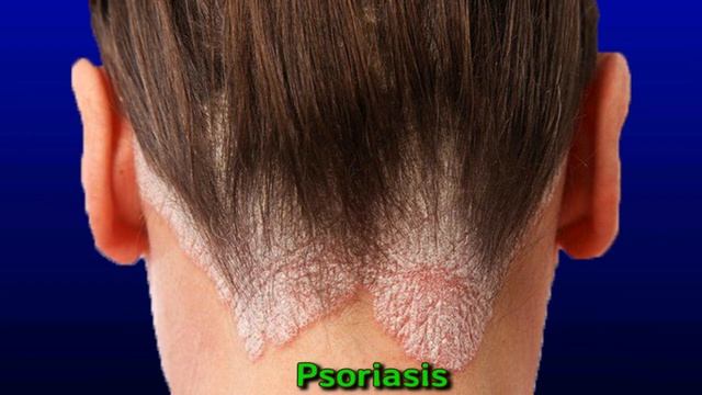 Swollen Occipital Lymph Node: Causes And Treatment смотреть онлайн