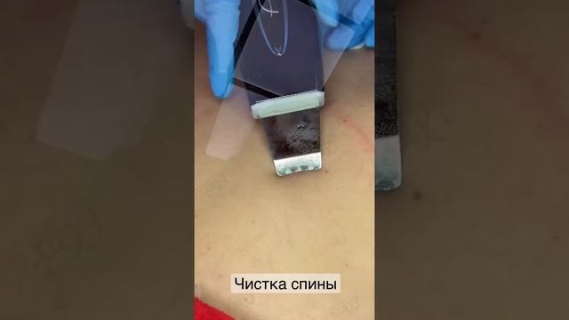 Чистка спины с дополнительным пилингом смотреть онлайн