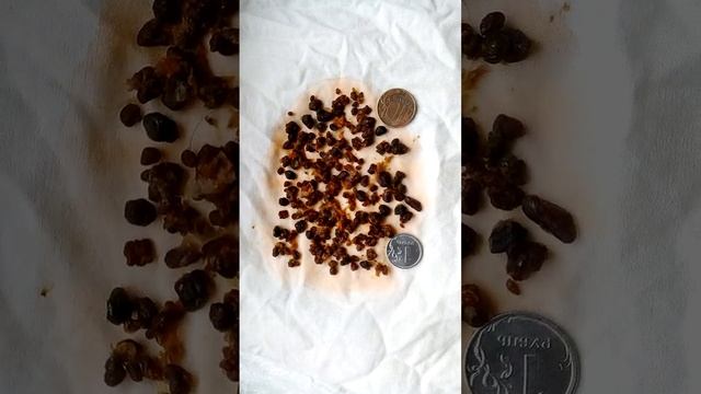 2 я очистка от камней из желчного пузыря, печени, поджел. железы смотреть онлайн