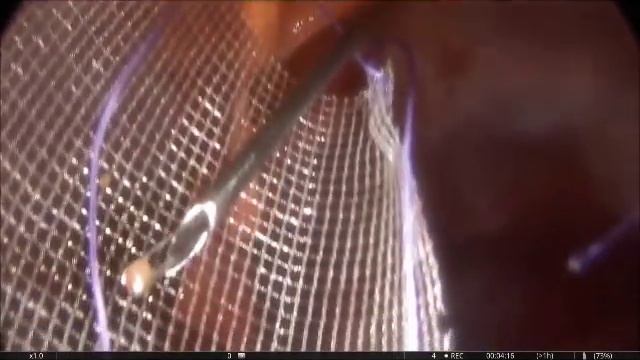 Лапароскопия при пупочной грыже