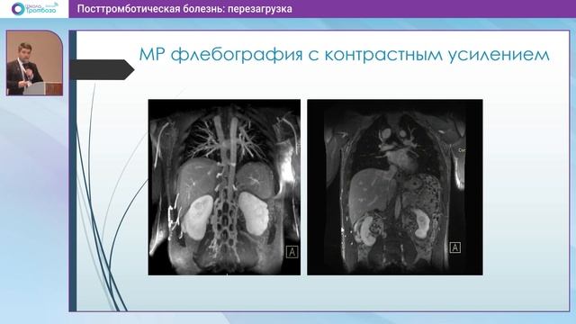 Доклад "Особенности лучевой диагностики ПТБ: место КТ и МРТ флебографии" (17.06.2023) смотреть онлайн