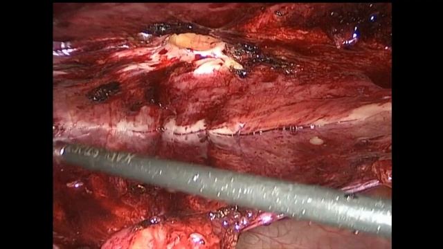 Laparoscopic TAPP Plus For Umbilical Hernia.