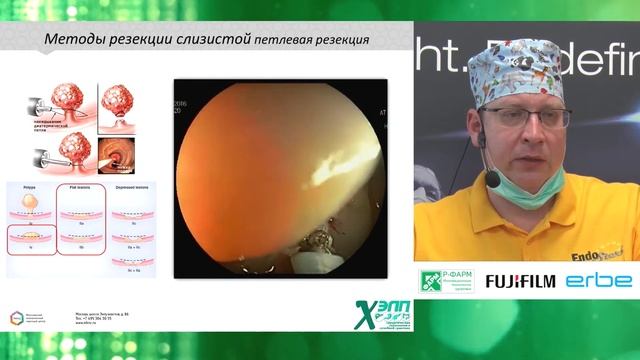 Эндоскопическое удаление эпителиальных образований толстой кишки. К. В. Шишин смотреть онлайн