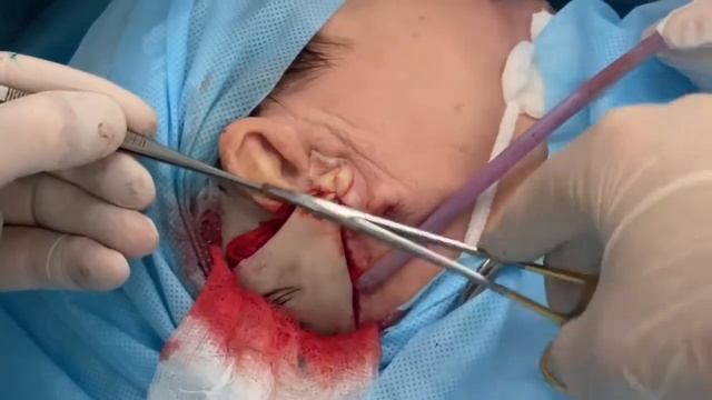 Рецедивирующая хондрома завитка уха справа. Гематома левой паховой области. смотреть онлайн