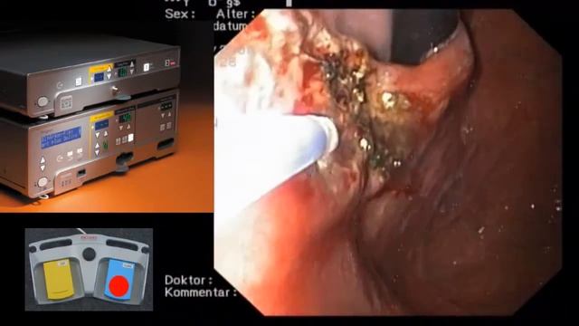 BOWA ARC PLUS электрохирургический аргоноплазменный аппарат для ARC 250, ARC 303, ARC 350,  ARC 400