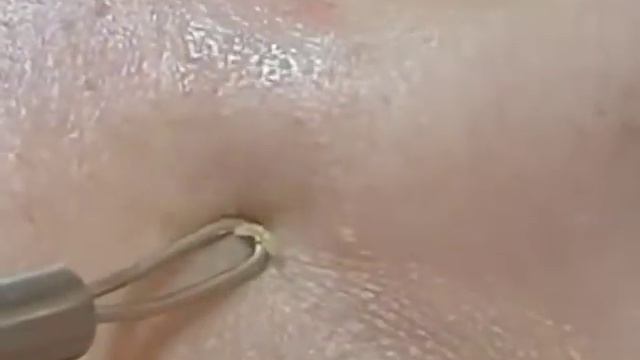 как выдавить прыщь Очередное отвратительное видео #52 смотреть онлайн