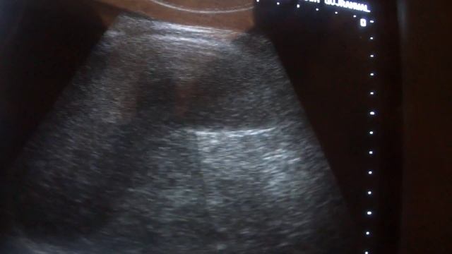 ultrasound SPLENIC HILAR EGION ENLARGED LYMPH NODES смотреть онлайн