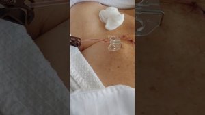 Игла Губера. Установка в порт для внутривенного введения.