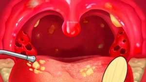 [ASMR] Анимация удаления миндалин, причина неприятного запаха изо рта! остановить движение