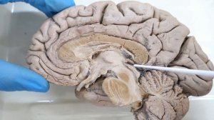 Третий желудочек головного мозга: стенки и сообщения