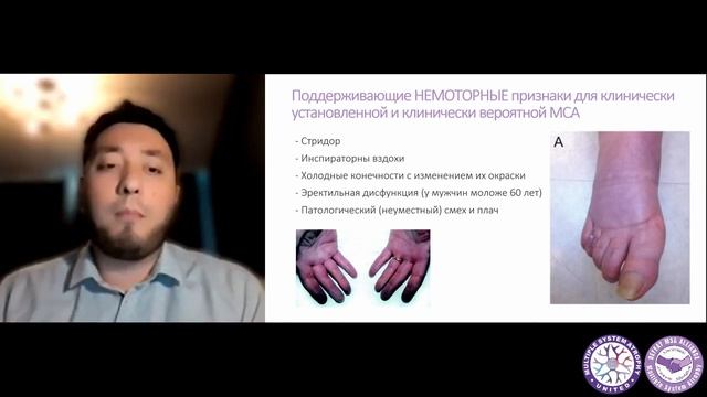 "Диагностика мультисистемной атрофии от критериев до биомаркеров" - Ойбек Тургунхужаев смотреть онлайн