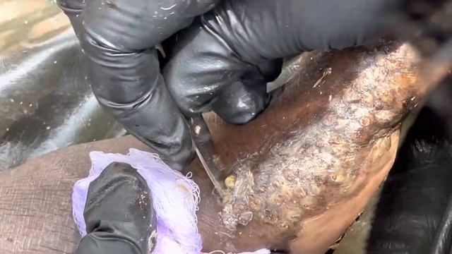 Moses's heavily jiggered left foot (part C) - FULL VIDEO, subscribe to www.riseupsociety.net смотреть онлайн