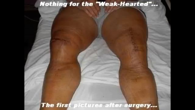 GIANT KILLER, Squat Accident Destroyed This Bodybuilder's Career, Jean-Pierre Fux