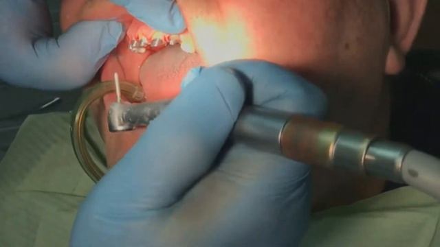 Протезирование пациента "К". Часть 2. Дневник врача- интерна. 4-я стоматология (архивное видео). смотреть онлайн