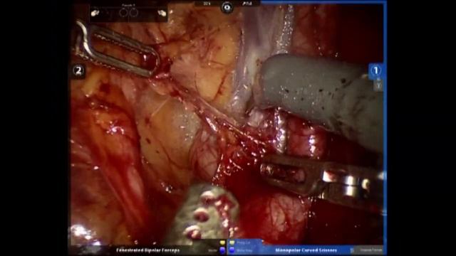 AUA Urology Teaching Videos:Robotic-Assisted Extended Lymph Node Dissection for Pelvic Malignancies смотреть онлайн