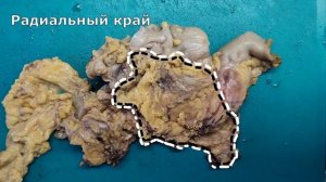 Рак толстой кишки #3 - опухоль и брюшина, хирургический край резекции.