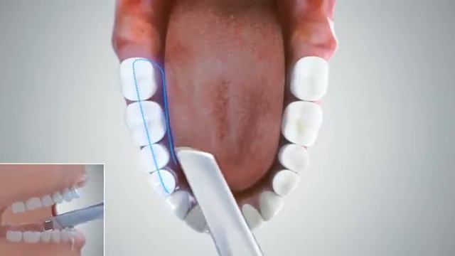 Bridge scan with Launca Intraoral scanner by Denstagenie смотреть онлайн