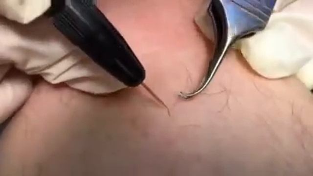 Электроэпиляция. Эпиляция. смотреть онлайн